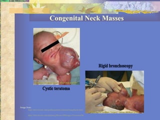 Congenital Neck Masses Image from:  http://bms.brown.edu/pedisurg/fetal/seminar/imagebank.html http://bms.brown.edu/pedisurg/Brown/IBImages/Teratoma/BronchospyTeratoma.html Cystic teratoma Rigid bronchoscopy 