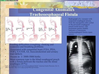 Congenital Anomalies Tracheoesphageal Fistula Feeding difficulties (coughing, choking and cyanosis) and breathing problems Associated with congenital heart (VSA, PDA, TOF), VATER, GI, musculoskeletal and urinary tract defects Occurs in  1/ 3000-5000 births Most common type is the blind esophageal pouch with a fistula between the trachea and the distal esophagus (87%) Clark, D. “Esophageal atresia and tracheoesophageal fistula” American Family Physician. Feb 15,  1999. Vol 59(4)  http://www.aafp.org/afp/99021ap/910.htlm Radiograph of a  neonate with suspected esophageal atresia.  Note the nasogastric tube coiled in the proximal esophageal pouch (solid arrow). The prominent gastric bubble indicates a concurrent tracheoesphageal fistula (open arrow)  