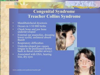 Congenital Syndrome Treacher Collins Syndrome Mandibulofacial dysotosis Occurs in 1/10 000 births Cheek bone and jaw bone underdeveloped External ear anamolies, drooping lower eyelid, unilateral absent thumb Respiratory difficulties Underdeveloped jaw causes tongue to be positioned further back in throat (smaller airway) Associated with OSA, hearing loss, dry eyes www.ccakids.com/syndrome/treacher.pdf 