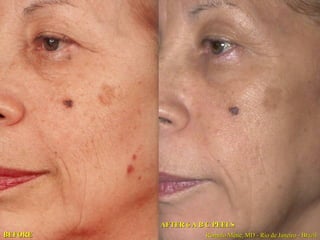 ABC o 30% Glycolic Peel
“PEELING” SUPERFICIAL - FOTOENVEJECIMIENTO INICIAL
(Fototipos IV & V)
Aplicar el Gel de ácido en la piel y remover con agua cuando la piel
desarrolle eritema color rosado.

“PEELING” MEDIANO - FOTOENVEJECIMIENTO MEDIO
(Fototipos I, II & III)
Aplicar el Gel de ácido en la piel y remover con agua cuando la piel
desarrolle un eritema de color medio rojo

“PEELING” PROFUNDO - FOTOENVEJECIMIENTO SEVERO
(Fototipos I & II)
Aplicar el Gel de ácido en la piel y remover con agua cuando la piel
desarrolle un eritema rojo intenso en el área tratada.

 