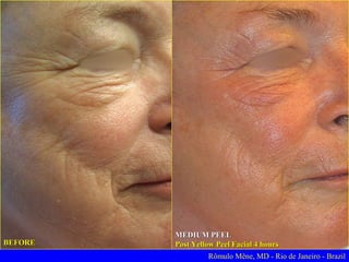 BEFORE

10 DAYS AFTER
DEEP YELLOW PEEL FACIAL

Rômulo Mêne, MD - Rio de Janeiro - Brasil

 