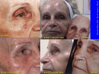 Rômulo Mêne, MD - Rio de Janeiro - Brasil

BEFORE

80 Y.O.
AFTER 2º YELLOW PEEL

AFTER 2º YELLOW PEEL

AFTER 2º YELLOW PEEL

BEFORE

BEFORE

 