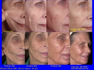 Post Imed. ABC PEEL
- 12 min.

21 June 2001

30 March 2005

30 March 2005

Rômulo Mêne, MD - Rio de Janeiro - Brazil

30 March 2005

8 days after ABC PEEL/
YELLOW PEEL FACIAL

 