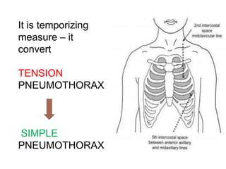 It is temporizing
measure – it
convert
TENSION
PNEUMOTHORAX
SIMPLE
PNEUMOTHORAX
 