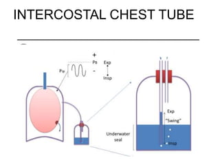 INTERCOSTAL CHEST TUBE
 