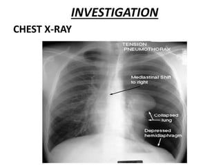 INVESTIGATION
CHEST X-RAY
 