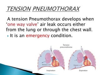 A tension Pneumothorax develops when
‘one way valve’ air leak occurs either
from the lung or through the chest wall.
 It is an emergency condition.
 