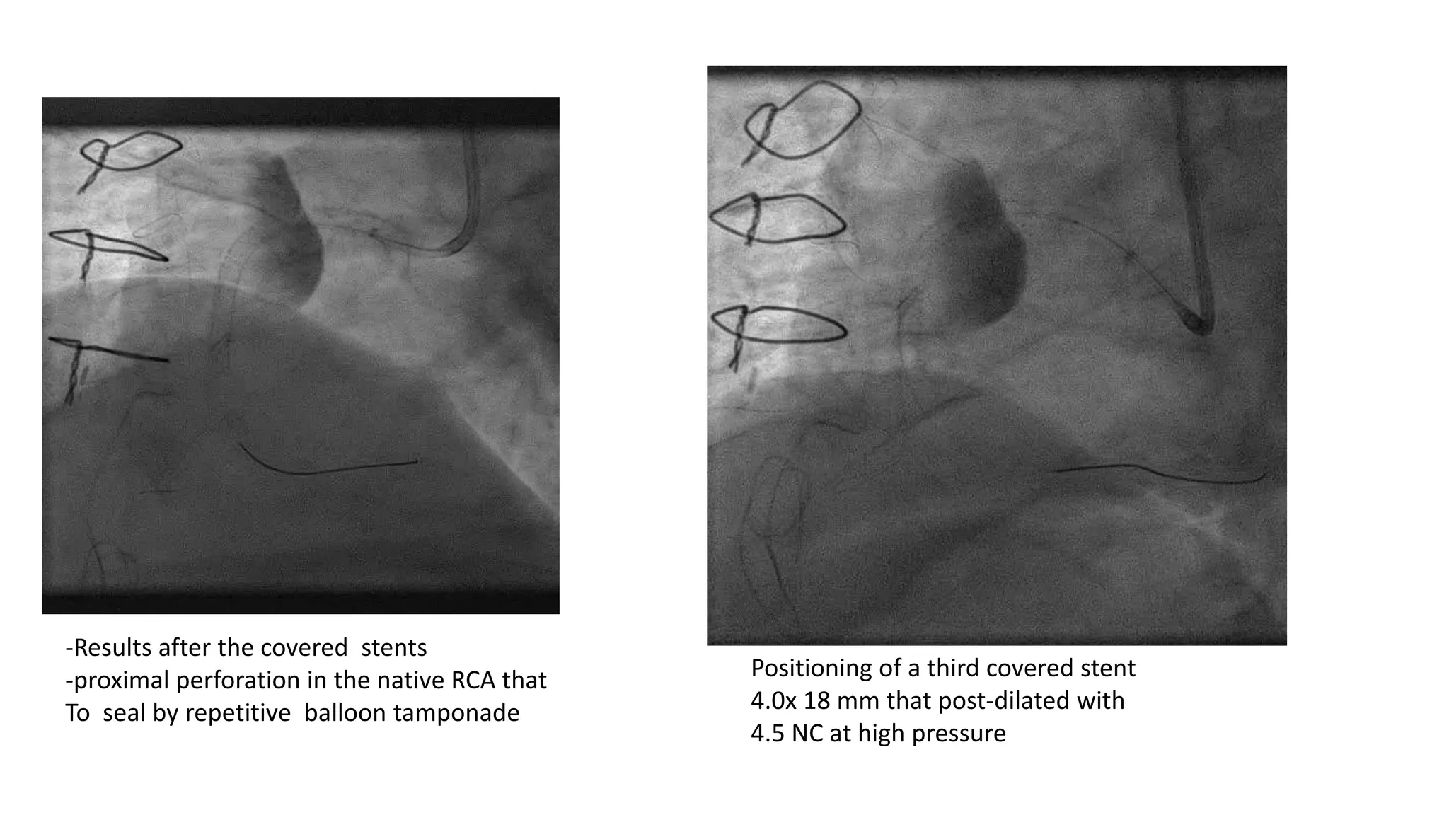 Giant Coronary Aneurysm - Hesham Abdelaziz | PPT