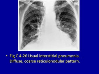 4 diffuse reticular or reticulonodular pattern | PPT