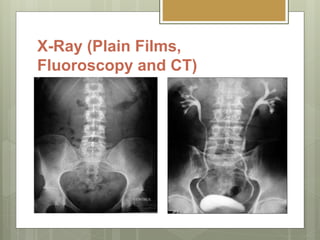 X-Ray (Plain Films,
Fluoroscopy and CT)
 Beam attenuation.
 