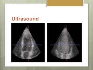 Ultrasound
 Decreasing reflection or increasing
backscatter of echoes.
 