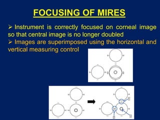 FOCUSING OF MIRES
 Instrument is correctly focused on corneal image
so that central image is no longer doubled
 Images are superimposed using the horizontal and
vertical measuring control
 