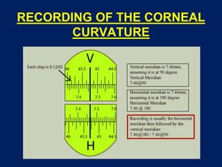 RECORDING OF THE CORNEAL
CURVATURE
 