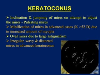 KERATOCONUS
 Inclination & jumpimg of mires on attempt to adjust
the mires - Pulsating mires
 Minification of mires in advanced cases (K >52 D) due
to increased amount of myopia
 Oval mires due to large astigmatism
 Irregular, wavy & distorted
mires in advanced keratoconus
 