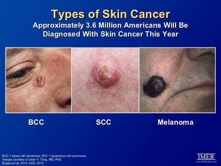 Basal Cell Skin Cancer Treatment