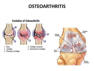 OSTEOARTHRITIS
 