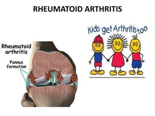 RHEUMATOID ARTHRITIS
 