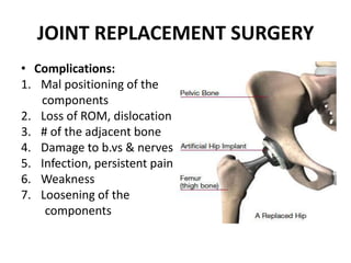 JOINT REPLACEMENT SURGERY
• Complications:
1. Mal positioning of the
components
2. Loss of ROM, dislocation
3. # of the adjacent bone
4. Damage to b.vs & nerves
5. Infection, persistent pain
6. Weakness
7. Loosening of the
components
 