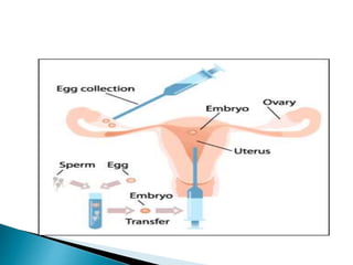 Artificial Reproductive Technology