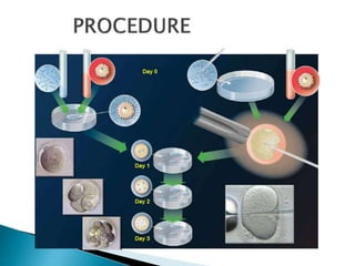 Artificial Reproductive Technology