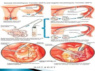 Artificial Reproductive Technology