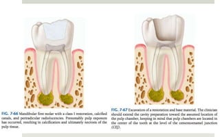 Access cavity preparation