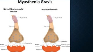 Acute flaccid paralysis gk