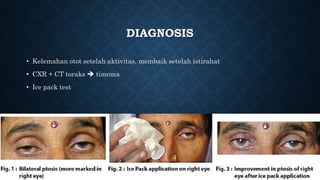 DIAGNOSIS
• Kelemahan otot setelah aktivitas, membaik setelah istirahat
• CXR + CT toraks  timoma
• Ice pack test
 