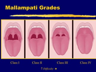 Mallampati Grades    Difficulty    Class I   Class II   Class III   Class IV 