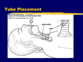 Tube Placement From TRIPP, CPEM 