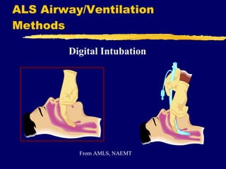 ALS Airway/Ventilation Methods Digital Intubation From AMLS, NAEMT 