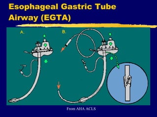 Esophageal Gastric Tube Airway (EGTA) From AHA ACLS 