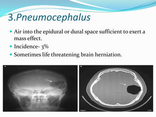 3.Pneumocephalus
 Air into the epidural or dural space sufficient to exert a
  mass effect.
 Incidence- 3%
 Sometimes life threatening brain herniation.
 