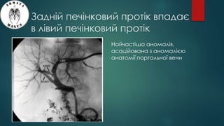 Задній печінковий протік впадає
в лівий печінковий протік
Найчастіша аномалія,
асоційована з аномалією
анатомії портальної вени
 