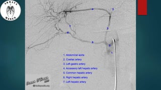 Anatomy of liver hilum