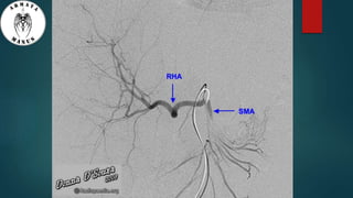 Anatomy of liver hilum