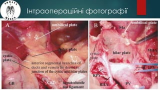 Інтраопераційні фотографії
 