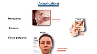 Complications
Hematoma
Facial paralysis
Trismus
Hematoma
Trismus
Facial paralysis
 