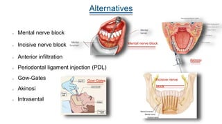 Alternatives
Mental nerve block
Incisive nerve block
Anterior infiltration
Periodontal ligament injection (PDL)
Gow-Gates
Akinosi
Intrasental
Mental nerve block
Incisive nerve
block
Gow-Gates
Akinosi
 