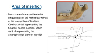 Area of insertion
Mucous membrane on the medial
(lingual) side of the mandibular ramus,
at the intersection of two lines
One horizontal- representing the
height of needle insertion, Other
vertical- representing the
anteroposterior plane of injection
 