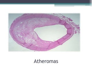 Atheromas
 