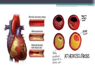 Atherosclerosis