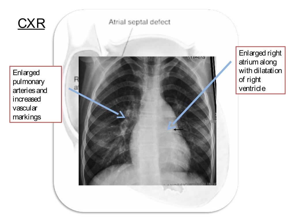 Atrial septal defect