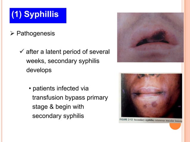 Bacterial infections (4)