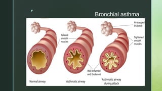 z
Bronchial asthma
 