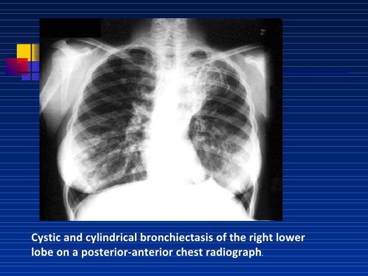 Bronchiectasis