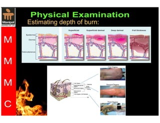 Estimating depth of burn: 
 