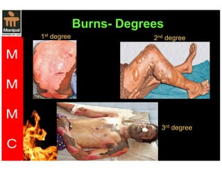 Burns- Degrees 
1st degree 2nd degree 
3rd degree 
 