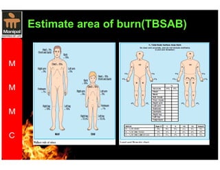 Estimate area of burn(TBSAB) 
 