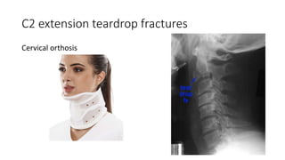 C2 extension teardrop fractures
Cervical orthosis
 